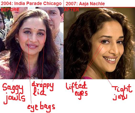 Bollywood Actresses Movies News Songs Bollywood Celebrities Plastic Surgery Boob Job And Botox