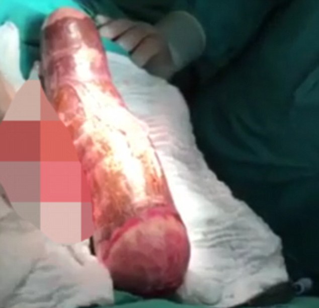 Costa Rican Man In Hospital After Using An Inch Cassava Root
