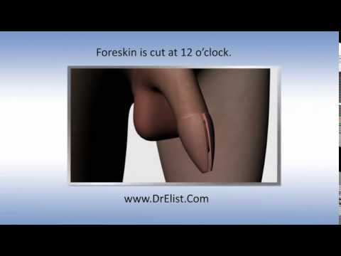 Dr Elist Reviews Adult Circumcision Surgery A Prerequisite For Penile Enlargement Surgery Youtube
