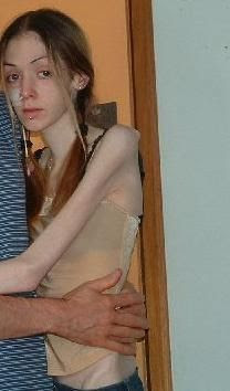 Horrors Of Anorexia Damn Cool Pictures