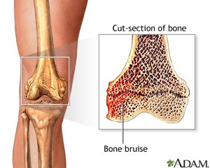 Knee Bone Bruise Treatment And Diagnosis Sports Injuries