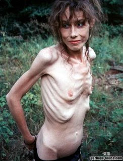 Medusa Anorexic Bulimic Pro Ana Mia Some Tips If You Want 1