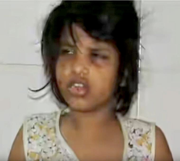 Mowgli Girl Likely Abandoned Parents Because She Is A Girl With Disabilities