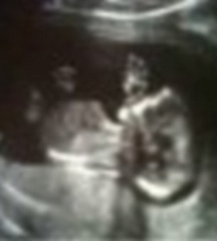 Soya Keaveneys Facebook Picture Shows The Scan Of Her Unborn Child The Youngster Has Attacked