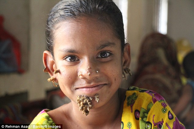 The Girl Known Only As Shahana Suffers From Verruciformis Also Known